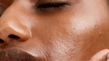 The best regimen for acne-prone skin