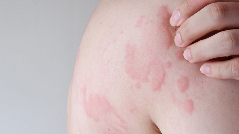 urticaria and chronic hives